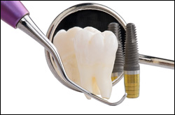 Dental Implants Lehi UT Dentist